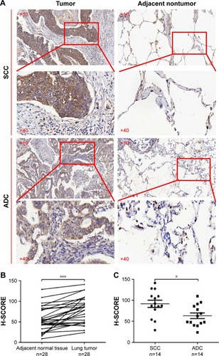 Figure 3 Immunohistochemistry for lung cancer tissues. (A) Representative images of lung cancer patients by immunohistochemistry (magnification: ×10, ×40). (B) H-SCORE of lung cancer and adjacent nontumor tissues. (C) H-SCORE of ADC and SCC.