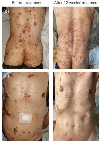Figure 1. Clinical photographs. Intermediate junctional epidermolysis bullosa improved after 12 weeks of treatment with dupilumab (loading dose 600 mg s.c. with successive injections of 300 mg every other week)