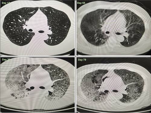 Figure 3 Computed tomography (CT) scan of the chest from different dates. Day 12, Right lung middle lobe and part of the lower lobe of lung atelectasis, both lungs can see calcification and cords; Day 64, Diffuse bilateral ground-glass opacities with mild interstitial changes; Day 75, Diffuse bilateral ground-glass opacities with the thickening of interlobular interval, exudation in both lungs increased significantly compared to previous (Day 64), considering the possibility of interstitial pneumonia; Day 79, Diffuse bilateral ground-glass opacities with the thickening of interlobular interval, multiple bronchiectasis of both lower lungs. The exudation of the upper lobe of the left lung was less than before (Day 75).