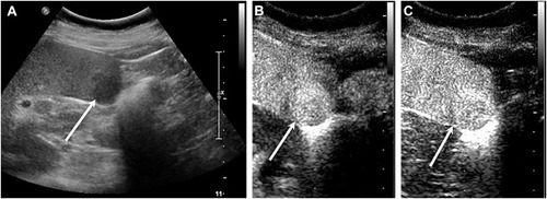 Figure 4 Splenic benign vascular tumor in a 48-year-old female patient. (A) B-mode US shows a normal-sized spleen with a 2.4 cm in diameter almost well-defined hypo-echoic lesion (arrow). (B) CEUS shows hyper-enhancing (arrow) in arterial phase (17 seconds after contrast injection). (C) CEUS shows sustained hyper/iso-enhancing (arrow) in parenchymal phase (105 seconds after contrast injection).