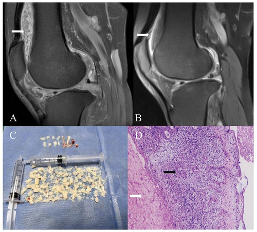 Figure 1. Magnetic resonance imaging, specimens, and pathological findings in the case. (A) Fat-suppressed T2-weighted imaging (T2WI) showing numerous ‘watermelon seed’-like rice bodies within the knee joint cavity, presenting as hypointense compared to joint effusion, with synovial proliferation. (B) Fat-suppressed T2WI showing a marked reduction in synovial proliferation. (C) Photograph of a large number of rice bodies retrieved from arthroscopic lavage. (D) Extensive fibrin exudation and necrotic degenerated tissue (white arrows), with focal formation of inflammatory granulomas (black arrows) (H&E, × 200).