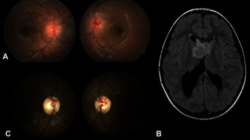 Figure 2 A patient with tuberous sclerosis complex presented with progressing worsening headaches associated with nausea/vomiting. The patient was found to have a mild left cranial nerve VI palsy on examination and papilledema with severe swelling of the optic nerve and macular exudates on dilated fundus exam (A). MRI revealed a subependymal giant cell astrocytoma with right univentricular hydrocephalus (B). After medical treatment with sirolimus, the papilledema resolved with mild pallor of both optic nerves (C).
