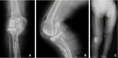 Figure 5 (A) Anteroposterior and (B) lateral postoperative radiographs of the final UKA implant, documenting correction of the anterior slope. AP radiograph showing that the valgus deformity was resolved postoperation (C).
