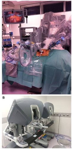 Figure 1 The setting of the da Vinci robotic system (A) during a right colon resection at the Careggi University Hospital; and the surgeon console (B).