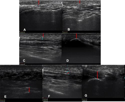 Figure 2 Measurement of skin and subcutaneous tissue in dorsal foot region (A), heel region (B), under the scaphoid (C) and under the metatarsal heads (D); measurement of plantar fascia at heel (E) and under the scaphoid (F); measurement of Achilles tendon at its insertion (G).