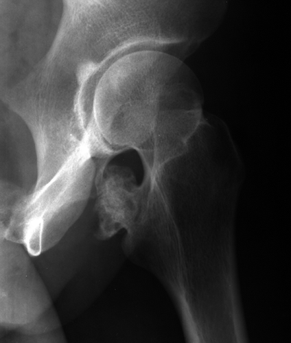Figure 1. Radiograph 19 years prior to presentation, showing a solitary osteochondroma of the proximal left femur.