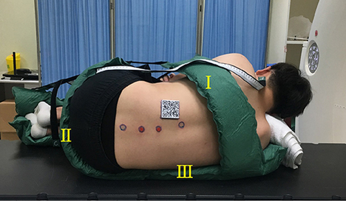 Figure 2 In-house modified vacuum cushion for fixation in the lateral decubitus position.