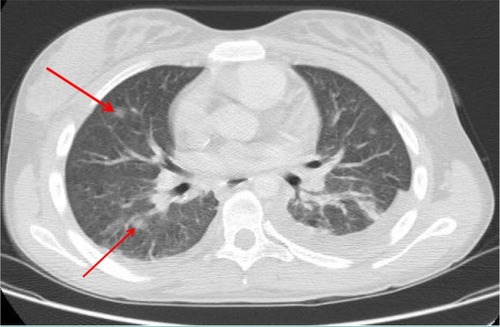 Figure 2 Computed tomography chest image with contrast of a 19-year-old female with relapsed neuroblastoma, Staphylococcus aureus bacteremia, and pulmonary nodules (arrows) that were initially concerning for invasive fungal disease.Notes: The patient was initially started on amphotericin and then underwent biopsy of the lesions. Both culture and histopathology revealed S. aureus; Amphotericin was discontinued without the development of other evidence of fungal disease.