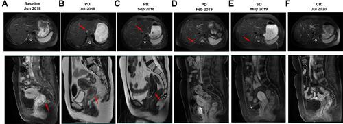 Figure 2 Magnetic resonance imaging (MRI) of the liver (upper) and cervical (lower) lesions at treatment milestones. (A) at baseline; (B) two weeks after IMRT directed to pelvis; (C) two months after IMRT directed to neck combined with brachytherapy and platinum-based chemotherapy (PR); (D) seven months after IMRT directed to neck combined with brachytherapy and platinum-based chemotherapy (PD). (E) three months after pyrotinib treatment (SD); (F) seventeen months after pyrotinib treatment (CR). The red arrows in upper and lower panels indicated metastatic live lesion and the primary cervical adenocarcinoma, respectively.