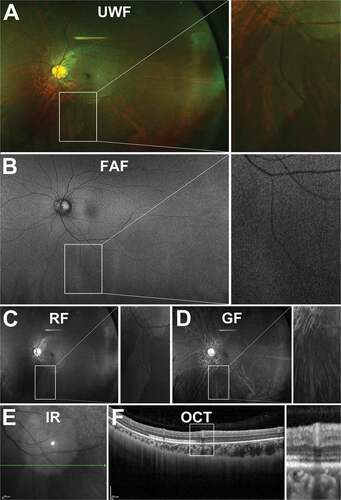 Figure 9. 22 year old Asian female with WWOP. (A) UWF imaging demonstrates irregular patches in the retinal periphery which are (B) hypofluorescent on FAF. Patches are visible on (C) red-free but less so on (D) green-free imaging. (E) Infrared imaging and (F) accompanying peripheral OCT at the margin of the lesion highlight the alterations to the ellipsoid zone in the outer retina. Abbreviations as in Figure 3.