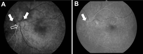 Figure 2 Initial left fluorescein angiography demonstrated a marked filling delay of the upper retinal artery (arrow). The framed arrow indicates the lower retinal artery. (A) 17.7 seconds and (B) 36.5 seconds after injection.