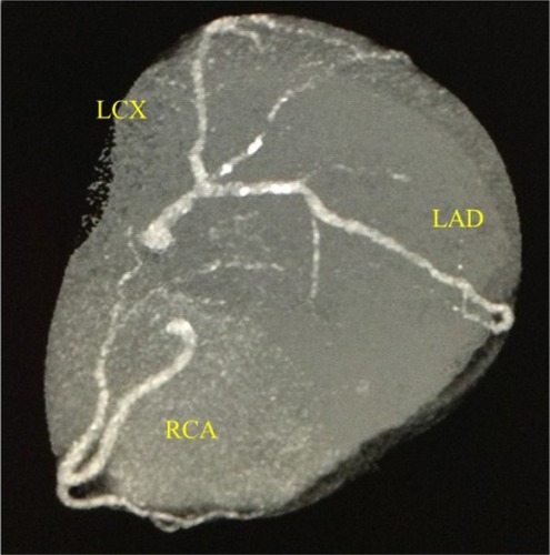 Figure 3 Coronary computed tomography.