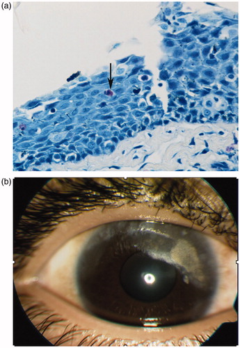 FIGURE 2. (a) Pathology slide showing intracytoplasmic inclusion bodies (arrow). (b) Slit-lamp photograph 6 months after treatment of trachoma showing a marked inprovement in pannus and lipid deposition.