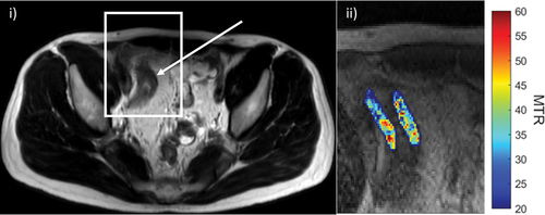Figure 3. Imaging and quantifying fibrosis. i) Axial T2-weighted image of the pelvis demonstrating a long stricture of the terminal ileum (arrow). ii) Corresponding magnetization transfer imaging of the stricture alongside a quantitative color scale shows decreased magnetization transfer ratio (MTR) in the wall of this segment with a range of 20 to 60.