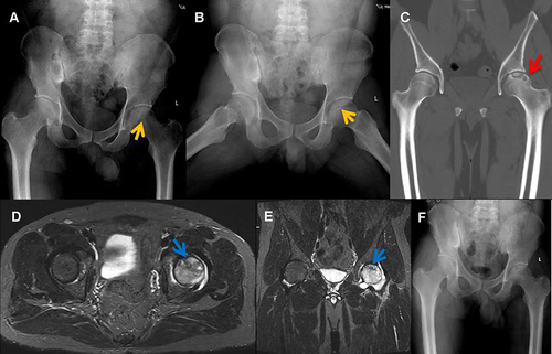 Figure 1 (A and B) X-ray demonstrated that the left femoral head exhibited a strip-like low-density area (yellow arrow) but no evidence of stenosis. (C) CT revealed the left femoral head remains regular, the continuity of the upper bone cortex is poor, patchy low-density areas (red arrow) can be seen under the articular surface, edge hardening, and slightly high-density foci can be seen considering the formation of dead bone. (D and E) MRI revealed necrosis of the left femoral head, and effusion in the left joint cavity (blue arrow). (F) No obvious abnormality in Hip X-ray half a year after discharge.