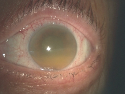 Figure 4 Lens proteins in the anterior chamber, phacolytic glaucoma.Citation3