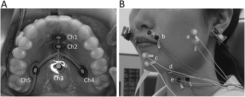 Figure 1. (A) occlusal view of the sensor sheet attached to the palate, (B) positioning of surface electrodes over the orofacial muscles.