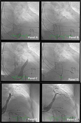 Figure 3. Access to the CS ostium from the right side (images in the right anterior oblique projection). Panel A: Due to enlarged right atrium, it is difficult to reach the ostium of the CS. A multipurpose guiding catheter is used, and two guidewires are inserted in the proximal part of the main CS, which is identified with a small volume of contrast. Note the large curve of the guiding catheter. Panel B: The wires are gently inserted deeper into the anterior part of the CS, and the multipurpose guiding catheter is also moved forward. Panel C: Contrast dye is injected to get an overview of the CS anatomy. Due to the sharp curve of the CS take-off and thus lack of stability of the system, it is not possible to move the outer coronary sinus guide forward. Panel D: More wires are added for extra support. Panel E: The outer coronary sinus guide can now be inserted into the main CS. Panel F: Selective venography distal in the CS identifies a possible target for placement of the lead.