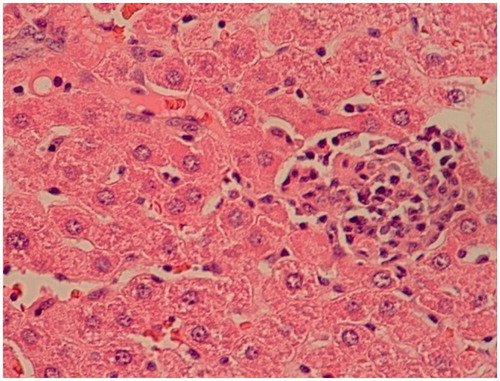 Figure 2. Microscopic structure of liver of a glibencalmide-treated diabetic rat showing moderate portal areas, mild piecemeal necrosis, and 1–4 foci per field. The slide stained with hematoxylin and eosin (original magnification ×10).