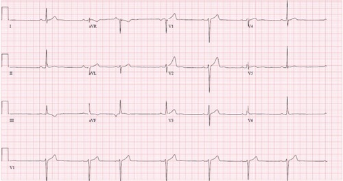 Figure 5 EKG second event.