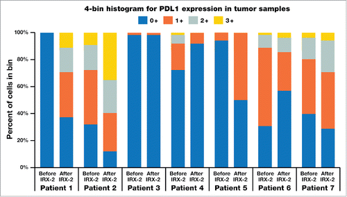 Figure 2. Changes from pre- to post-treatment with IRX-2 in PDL1 expression as quantitated by H-score intensity levels for each of the 7 substudy patients.