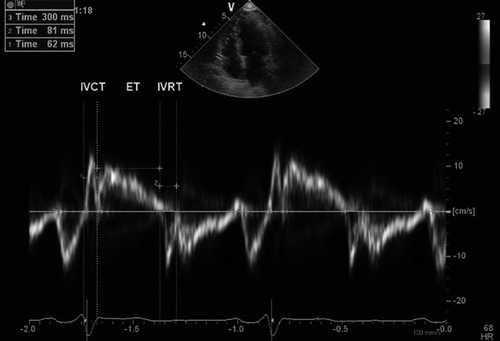 Figure 1.  Intervals measured from pulsed tissue Doppler obtained from the lateral tricuspid annulus. ET, ejection time; IVCT, isovolumic contraction time; IVRT, isovolumic relaxation time; MPI, myocardial performance index = (IVCT+IVRT)/ET.