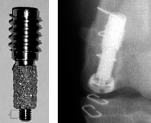 Figure 1. Illustrations of the model. The polyethylene plug transferring load from the tibial cartilage to the implant is not shown. The implant is surrounded by a 0.75-mm gap, and it is loaded during each gait cycle. In addition, there is a constant flow of joint fluid passing the surface. The HA-coated implants were inserted in the left femur and the growth factor-coated implants in the right femur.