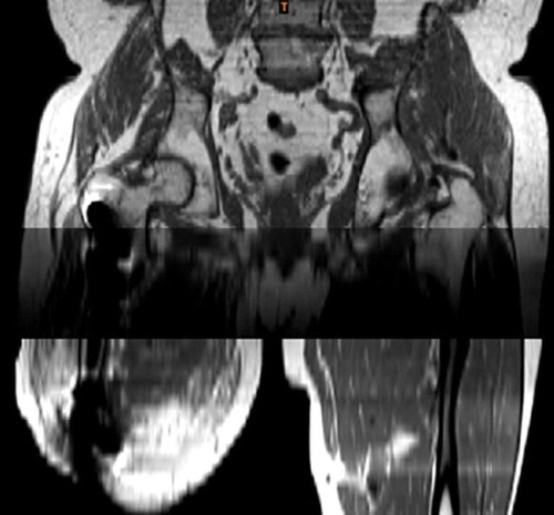 Figure 3. Coronal plane MR image at baseline. Note: the presence of metal artefacts at the distal end of the residual limb and the abrupt transition between adjacent stacks after combining the MR volumes.