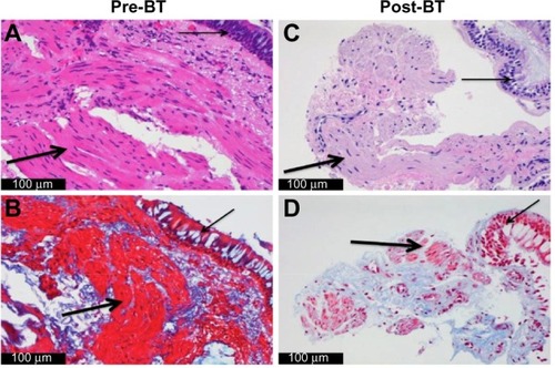 Figure 1 Airway histology before and after BT.