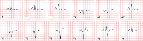 Figure 6 ECG features in pulmonary disease. The tracing illustrates sinus rhythm with a typical manifestation of P-pulmonale, particularly visible in leads II, III, aVR aVF, and V1-V2.