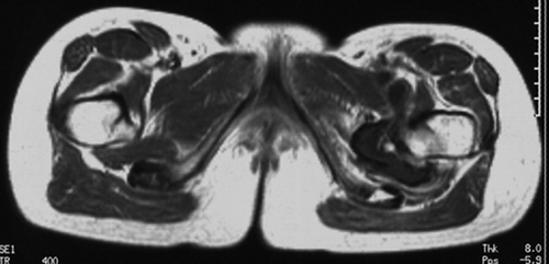 Figure 3a. Axial T1-weighted MRI showing continuity of the osteochondroma with the lesser trochanter. In contrast to the CT image in Figure 4, MRI does not show clear distinction between the exostosis and the overlying mass. The demarcation between mass and the surrounding tissue is sharp.