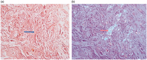 Figure 5. (a) and (b) Plaque biopsy shows amyloid deposit confirmed by Congo red staining with apple green birefringence.
