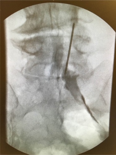 Figure 1 Anteroposterior fluoroscopic image of contrast injected through the first epidural catheter which was placed showing spread only to right-sided nerve roots.