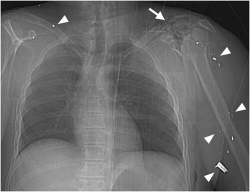 Figure 4. Part of a topogram at chest level showing multiple ballistic fragments (arrowheads) in the soft tissues of the right lower neck and the left upper arm. Note the comminuted fracture of the left shoulder (arrow). Lungs and mediastinum seemed unaffected. The victim died of severe ballistic head injury (not shown).