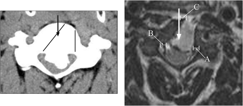 Figure 4. Left: The arrow indicates the center of the vertebral body. The two lines represent the ideal trapezoid bony resection. Right: A is the remaining posterior body in millimeters from the ipsilateral medial margin of the pedicle; B is the same portion from the opposite side; and C is the remaining body from the center.