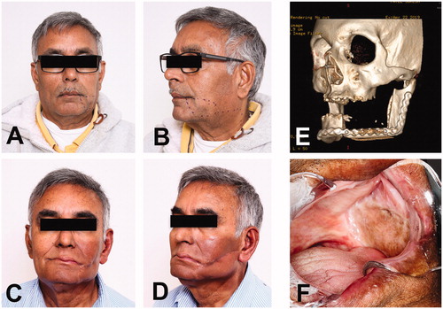 Figure 5. Long-term follow-up. (A-B) Preoperative pictures for evaluation of the surgical outcome. (C-D) Frontal and oblique views fourteen months after surgery. Patient has completed radiation therapy. (E) Image of CT facial bones 3D reconstruction with satisfactory osseous alignment between the bony segment of radius and remaining mandible with no blast or lytic process. (F) Intraoral image showing the left buccal vestibule and its lining with the skin paddle of radial forearm free flap.