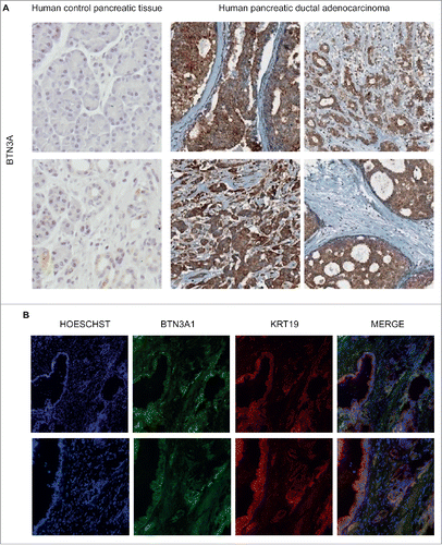 Figure 1. BTN3A epithelial expression in human pancreatic tumors. (A) Immunohistochemical characterization of BTN3A expression assessed in human control pancreas (peritumoral tissue) and human inflammatory primary pancreatic tumors Tissue Micro Array (TMA). Representative staining with anti-BTN3A mAb. Magnification x10. (B) Immunolocalization of BTN3A and keratin19 (KRT19). Merged images show the co-localization of BTN3A and KRT19 in pancreatic tumor tissue. Magnification x10 (upper panel) and x20 (lower panel).