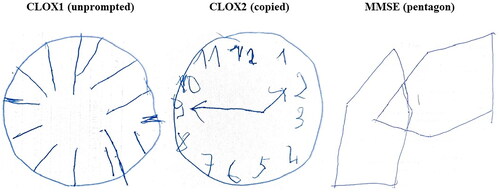 Figure 2. CLOX1, CLOX2 and pentagon results from a patient’s MMSE with no overall cognitive decline.