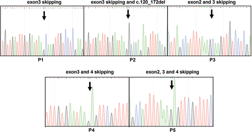 Figure 5. Analysis of alternatively spliced products from type I and II deficiency. PCR products comprising different alternative products (P1–P5) were isolated from the gel, cloned, and sequenced from two directions. The skipping of different exons found in P1, P2, P3, P4, and P5 and mutations are shown.