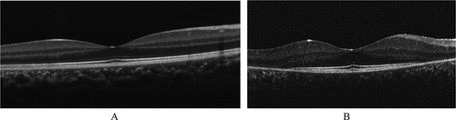 Figure 3. Ellipsoid zone disruption shown on a 9-year-old USH1 patient (A) compared to control (B). Usher syndrome image provided by Dr Jonathan Ruddle, Melbourne Children’s Eye Clinic. Control image provided by Dr. Marianne Coleman from the Australian College of Optometry.