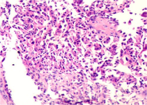 Figure 2 Stained sample of bone metastasis of lung adenocarcinoma, original magnification ×400.
