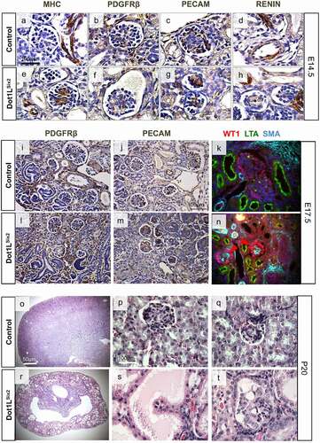 Figure 8. (a-n) Immunohistochemical analysis of selected glomerular and vascular smooth muscle markers in Dot1LSix2 kidneys. Dot1LSix2 glomeruli show ectopic/enhanced Myosin Heavy Chain (MHC) expression and Smooth Muscle Actin (SMA) in the mesangium at E14.5 and E17.5, respectively. Endothelial and juxtaglomerular cell markers are preserved. (o-t) P20 Dot1LSix2 kidneys exhibit diffuse glomerulocystic disease with microaneurysm formation. (N = 4/group)