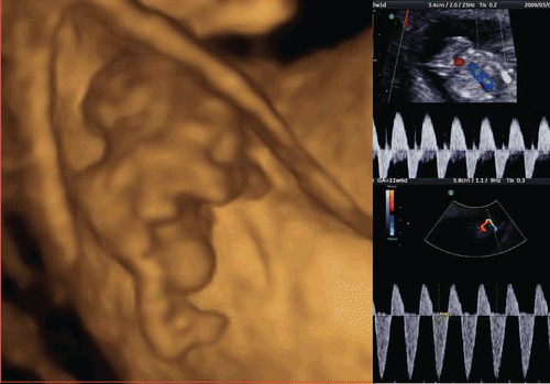 Figure 26.  Iniencephaly at 12 weeks of gestation. Left; 3D reconstructed image. Acrania, short body with dorsoflexion are well demonstrated. Right; This fetus had reverse flows of descending aorta (right upper) and umbilical artery (right lower) and intrauterine fetal demise was confirmed one week later.