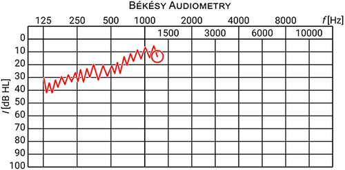 Figure 2 Example of a threshold curve in Bekesy audiometry.