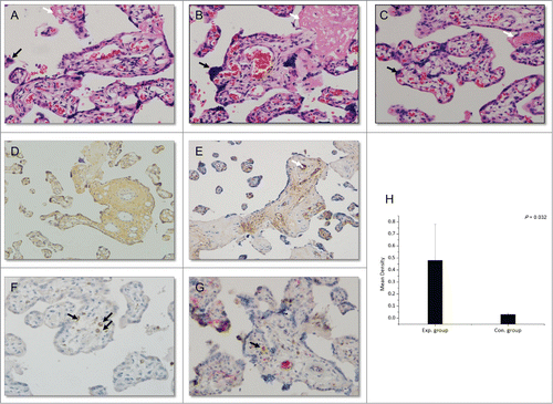 Figure 3. Histopathological changes in the placenta (hematoxylin-eosin; magnification, ×200, A–C) and immunohistochemical staining (magnification, ×200, D–F: DAB staining, G: DAB and AP-Red staining). (A) Section of placenta from late pregnancy of a healthy woman. (B) Section of placenta from a woman in the control group (HBV-infected women without HBIG injections). (C) Section of placenta from a woman in the experimental group (HBV-infected women receiving HBIG injections). Black arrows: syncytial knotting; white arrows: fibrinoid necrosis. (D) HBsAg staining. (E) HBIG staining. White arrow: villous capillary endothelial cells. (F) CD68 staining. Black arrows: Hofbauer cells. (G) CD68- and HBIG-double-positive immunohistochemical staining. Black arrow: HBIG in Hofbauer cells. (H) Comparison of HBIG intensity between the groups.