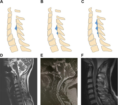 Figure 5 COLF distribution on T2-weighted sagittal MRI. (A and D) Single-segment distribution; (B and E) two-segment distribution; (C and F) multiple-segment distribution.