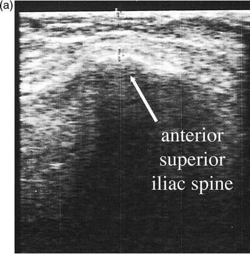 Figure 2. Exemplary depiction of ultrasound examination of one patient. (a) Static, sagittal B-mode image of the anterior superior iliac spine. In this particular case, the distance from skin to bone measured 10 mm. (b) Static, sagittal B-mode image of the symphysic area. Here, the distance from skin to bone measured 17 mm.