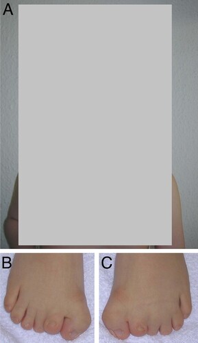 Figure 1 A) Facial view of the patient with GCPS-CGS at the age of 6 years. Note, broad nasal root and skull abnormality. B) and C) right and left foot with polydactyly and syndactyly.