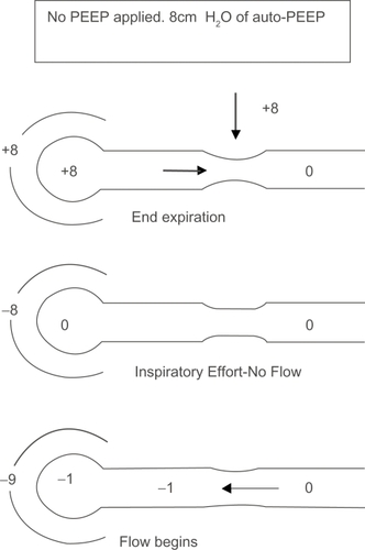 Figure 2A Effect of auto-PEEP on work of breathing (WOB). In the presence of airflow obstruction the alveoli remain inflated at end expiration. This results in alveolar pressure greater than atmospheric pressure. Without any inspiratory effort intra-pleural pressure equals alveolar pressure. A negative pressure greater than the auto-PEEP is required for the airflow to begin.