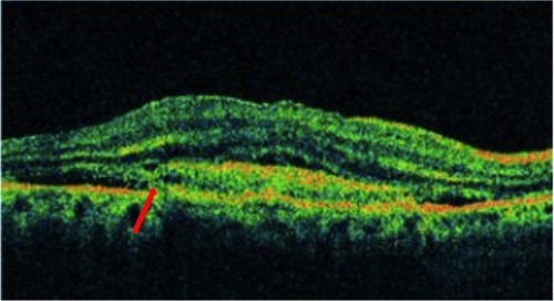 Figure 5 Choroidal neovascular membrane showing disruption of the photoreceptor ISel band, ELM, and RPE (red arrow).